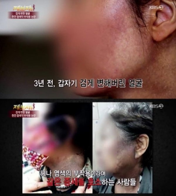 헤나 염색 부작용 (사진: KBS2 '제보자들')
