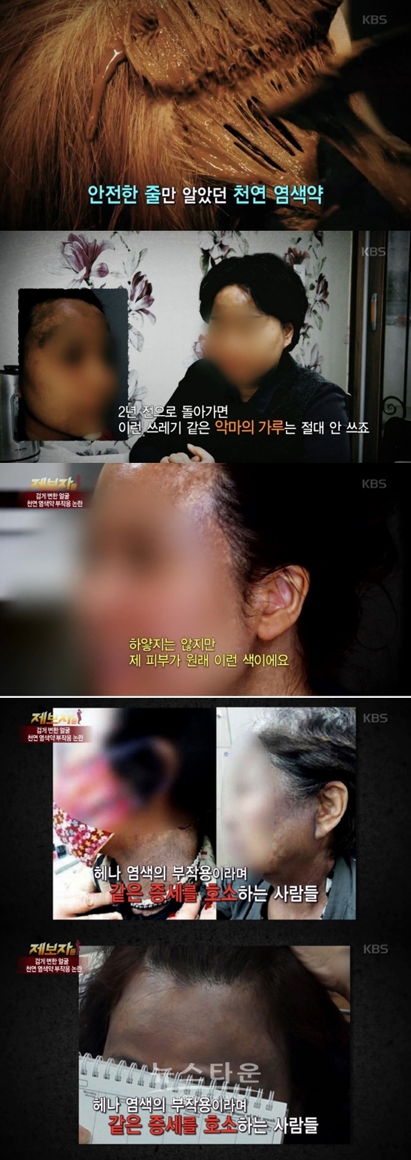 헤나염색 부작용 (사진: kbs)