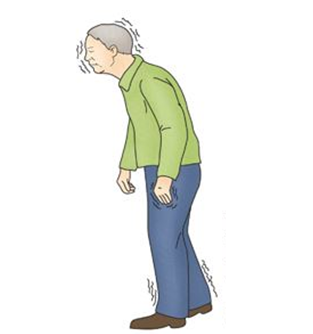 사진설명: 파킨슨병 환자의 주요 증상: 손떨림, 행동이 느려짐, 근육이 뻣뻣해짐 등 운동성과 인지기능의 퇴행성 상실
