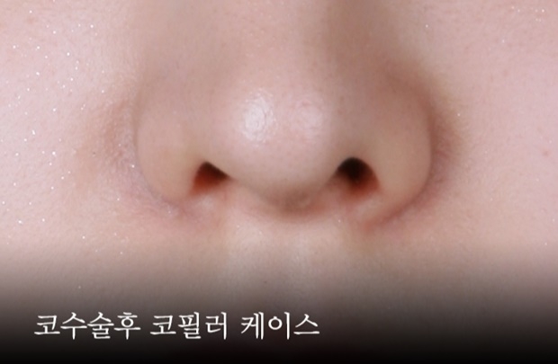 (사진: 청담동 로즈피부과)