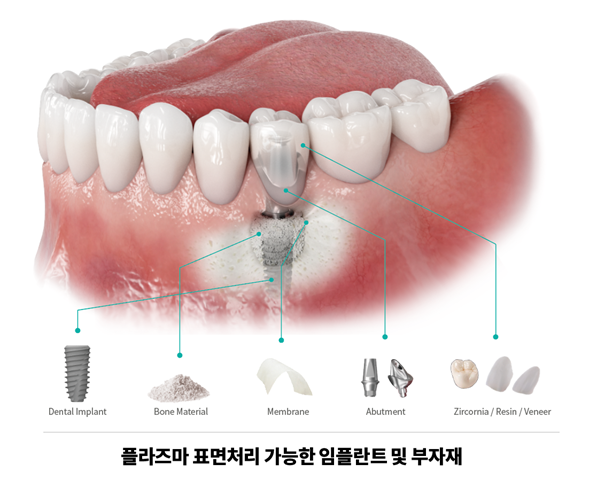 플라즈마 표면처리 가능한 임플란트