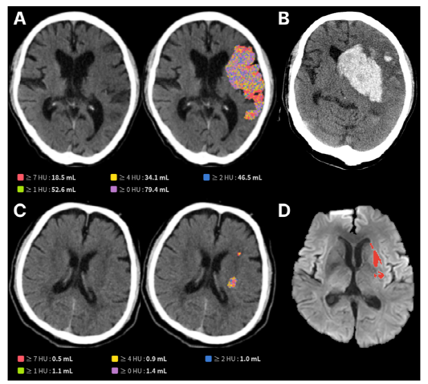 제이엘케이, AI 뇌경색 최신 연구 논문 Frontiers in Neuroscience에 발표 “예후 예측도 AI로”